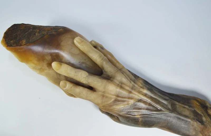 The Hand of Fannie Storr Nhs